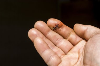 Parmak yara kesme ve iki cerrahi dikişler katlanmış.