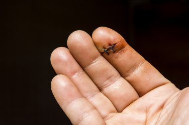 El bir parmak kurulan iki absorbe olmayan cerrahi dikişler olduklarını.