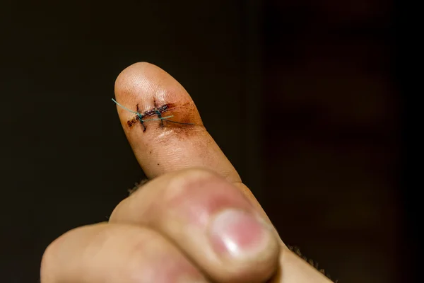 Op de vinger zijn twee niet-absorbeerbare chirurgische hechtingen. — Stockfoto