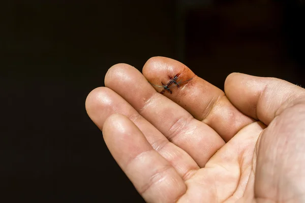 Finger wound cut and folded two surgical sutures. — Stock Photo, Image