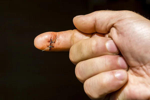 Dedo índice de su mano derecha con dos suturas quirúrgicas . — Foto de Stock