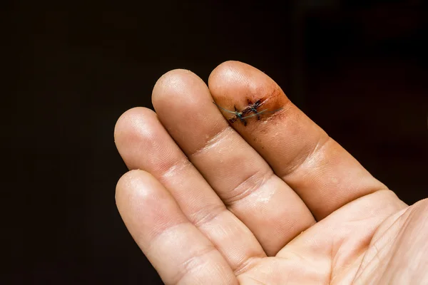 En un dedo de la mano se fundan dos suturas quirúrgicas no absorbibles . — Foto de Stock