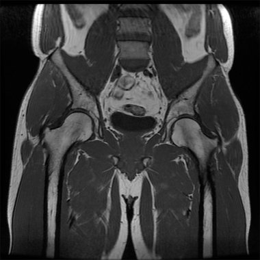 Erkek kalçasının manyetik rezonans görüntüsü. Sağ kalça kemiğinde osteoartrit gözlemlendi..