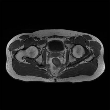Erkek kalçasının manyetik rezonans görüntülemesi. Sağ kalça kemiğinde osteoartrit gözlemlendi..