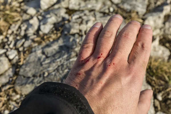 Herido su mano en las piedras — Foto de Stock