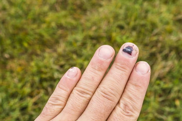 Hematoma subbungual no dedo médio — Fotografia de Stock