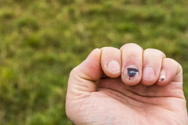 Subungual hematoma di jari-jari kakinya — Stok Foto