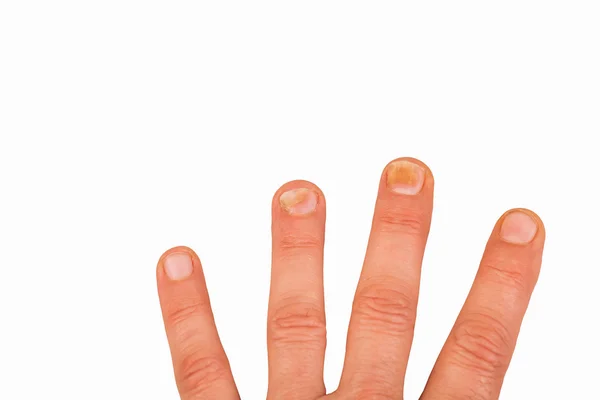 Fingernägel mit Nagelpilz — Stockfoto