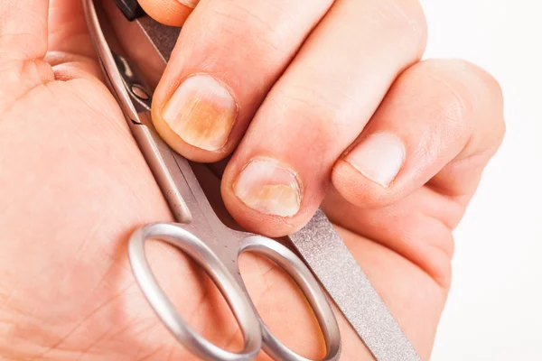 Uñas con hongos en las uñas — Foto de Stock