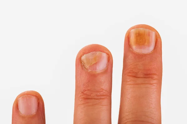 Fingernails with nail fungus — Stock Photo, Image