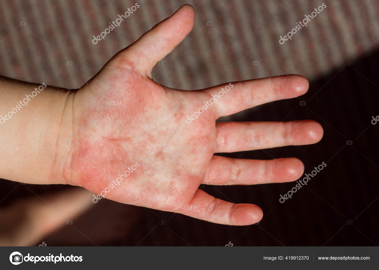 Rash On Knuckles