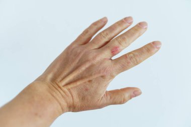 Yaralı bir kadın eli, parmağında çizik, yaşlılık lekeleri ve buruşuk bir cilt.