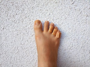 Ayak parmaklarında nasır olan bir kadının bacakları. Ayak derisi bakımı ve nasırların ve nasırların önlenmesi. Kesik deriler için ilk yardım. Kuru topuklar, kurumuş cilt. Sağlıksız ayak derisi kavramı. Güzellik.