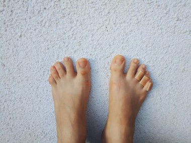 Ayak parmaklarında nasır olan bir kadının bacakları. Ayak derisi bakımı ve nasırların ve nasırların önlenmesi. Kesik deriler için ilk yardım. Kuru topuklar, kurumuş cilt. Sağlıksız ayak derisi kavramı. Güzellik.