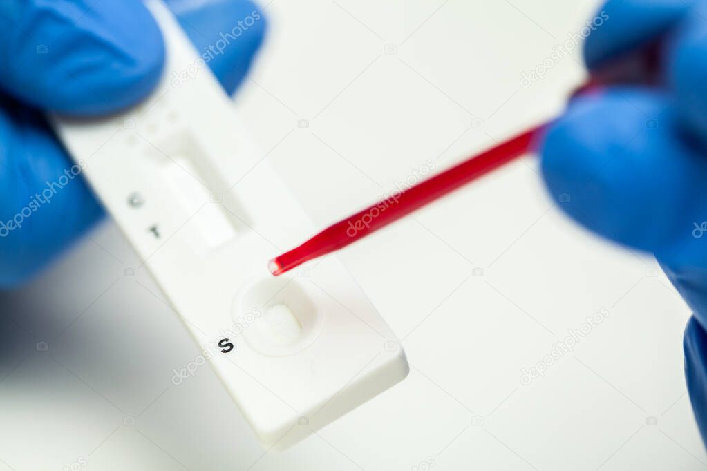 Lab scientist performing rapid diagnostic test RDT for antibodies to detect presence of viral protein antigens expressed by COVID-19 corona virus disease,CDC quick fast antibody point of care testing