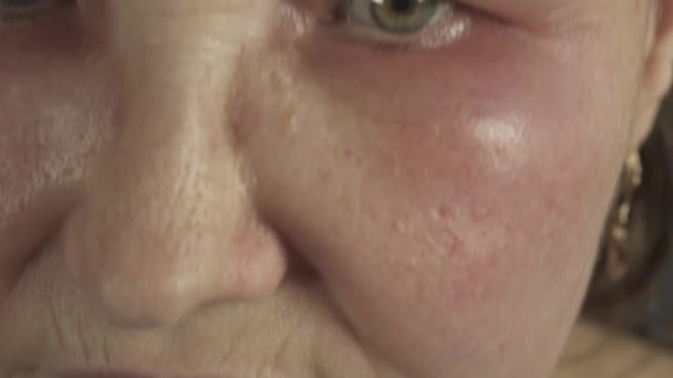 Allergy Scalp Hair Coloring Swollen Face Skin Reaction — Vídeo de Stock