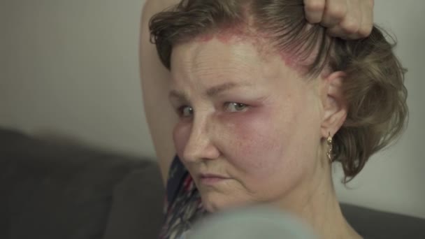 Allergie Sur Cuir Chevelu Après Coloration Des Cheveux Visage Gonflé — Video