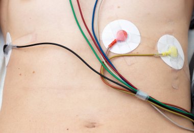 Taşınabilir holter elektrotları yakın planda görüntüler. Kalbin elektriksel aktivitesi kontrol ediliyor.