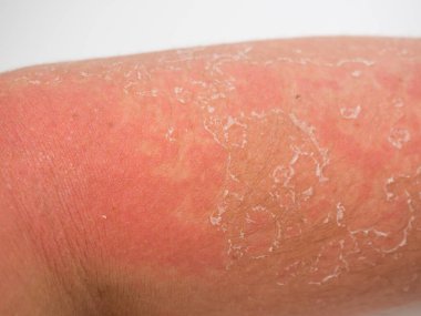 sunburn on the skin, severe tan on the arm
