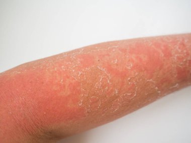 sunburn on the skin, severe tan on the arm