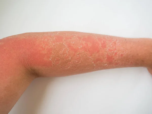 Sunburn Skin Severe Tan Arm — Photo