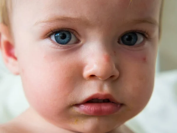 Close Child Face Bitten Mosquitoes Stained Porridge —  Fotos de Stock