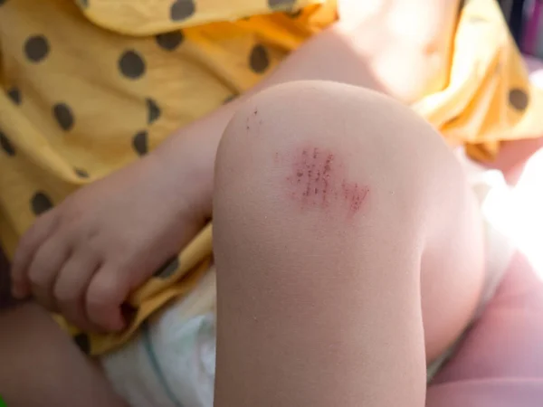 孩子腿上的伤口在路上摔倒了小孩膝盖上的擦伤近身 — 图库照片