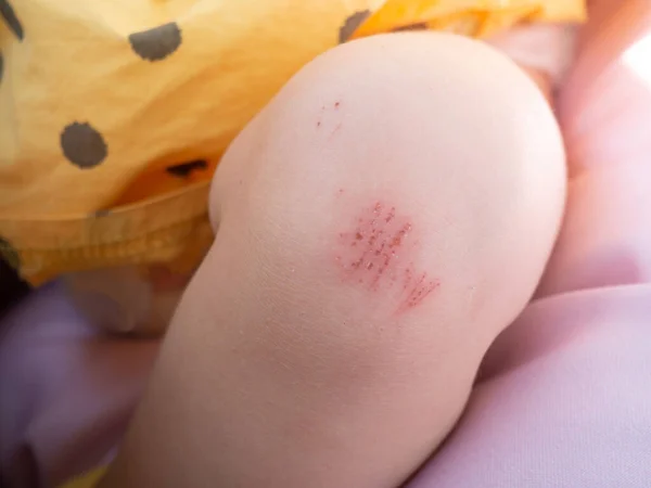 Une Blessure Jambe Enfant Tombé Sur Route Abrasion Sur Genou — Photo