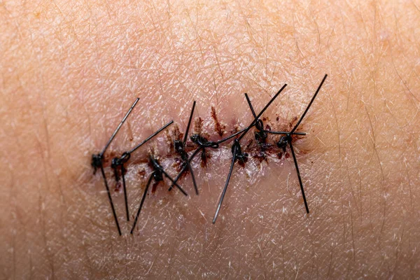 Yaradan alınmadan önce siyah cerrahi dikişler. Omuz ameliyatından sonra yaraların iyileşmesine yakın.. 