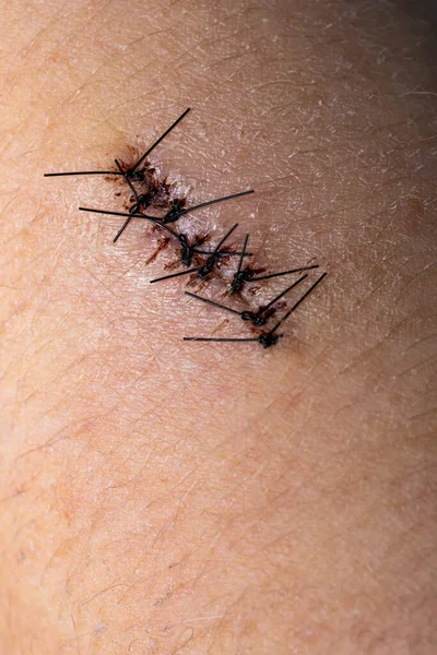 Yaradan alınmadan önce siyah cerrahi dikişler. Omuz ameliyatından sonra yaraların iyileşmesine yakın.. 