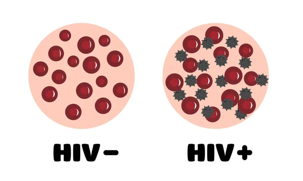 血液中のHiv Hivの有無にかかわらず Hivに感染した人の血 顕微鏡下の血液 世界の援助の日 ベクターイラスト — ストックベクタ