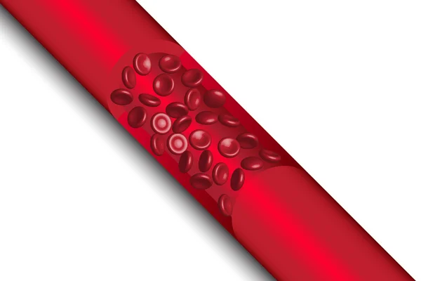 Rote Blutkörperchen, die bei Arteriosklerose fließen, Abbildung, Vektor — Stockvektor