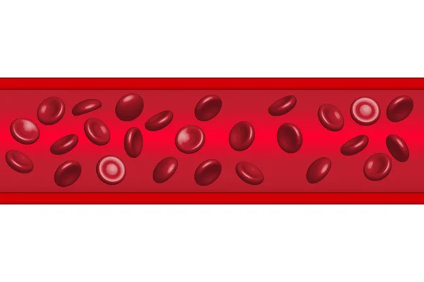 Glóbulos rojos que fluyen en la aterosclerosis, ilustración, vector — Vector de stock