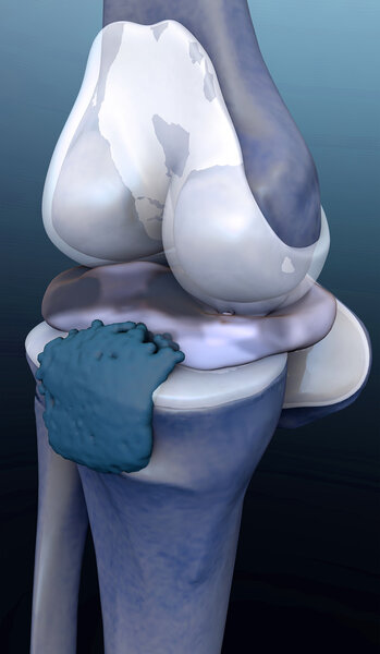 Кость, нога
