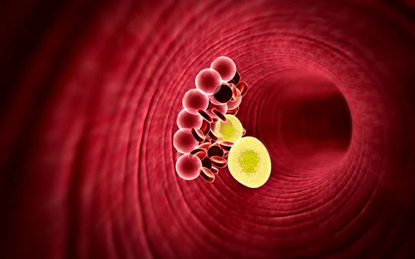 Cholesterol, blood vessel — Stock Photo, Image