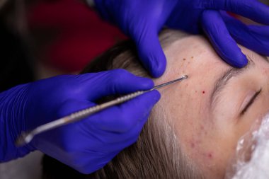 Güzellik salonunda mavi eldivenli genç bir kozmetik uzmanı cilt temizliği, sivilce sıkma, yakın çekim yapıyor. Yan görünüm