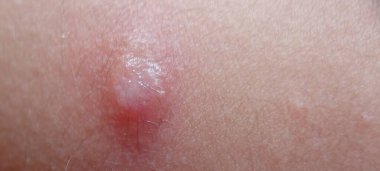 Bazal hücre karsinomu. Varicella virüsü ya da su çiçeği kabarcığı kızarıklığı yakın çekim