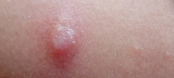 Bazal hücre karsinomu. Varicella virüsü ya da su çiçeği kabarcığı kızarıklığı yakın çekim