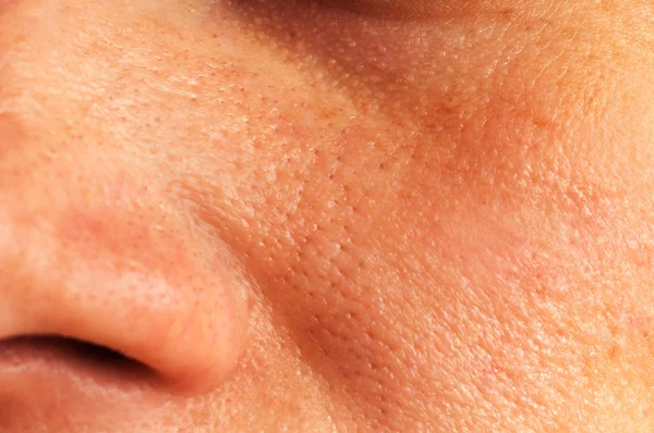 顔の脂性肌 — ストック写真