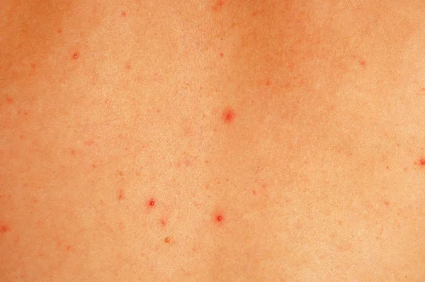 Acne body — Stock Photo, Image