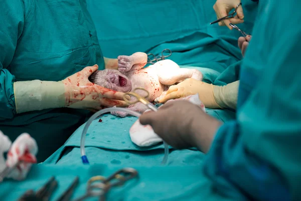 Echte operatie voor cesarean afdeling — Stockfoto