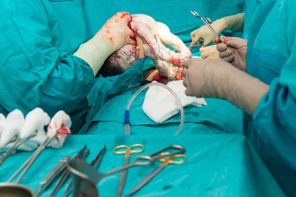 Echte operatie voor cesarean afdeling — Stockfoto
