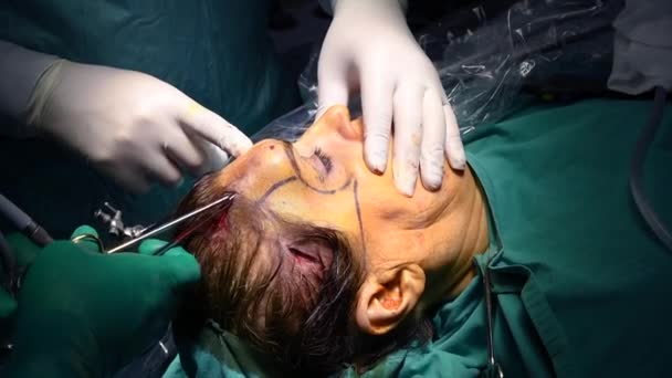Sollevare Chirurgicamente Sopracciglia Chirurgia Plastica Cosmetologia Mani Del Medico Primo — Video Stock