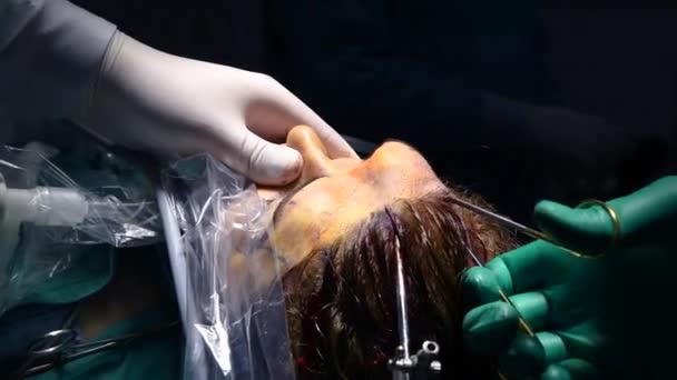 Surgically Lifting Eyebrows Plastic Surgery Cosmetology Close Doctor Hands Eyebrow — Stock Video