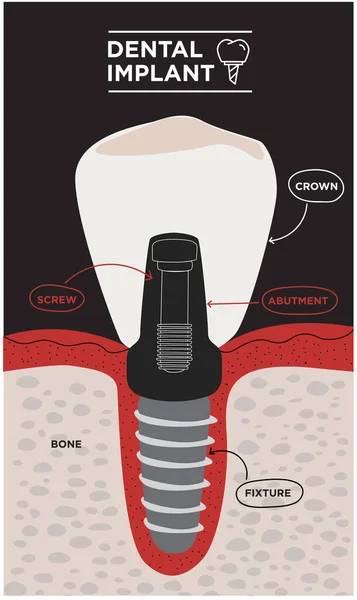 Структура Зубних Імплантатів Медична Освітня Інфографіка Імплантація Зубів Інформація Векторні — стоковий вектор