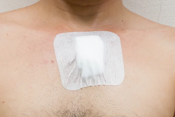 Wound from surgery at the chest — Stock Photo, Image