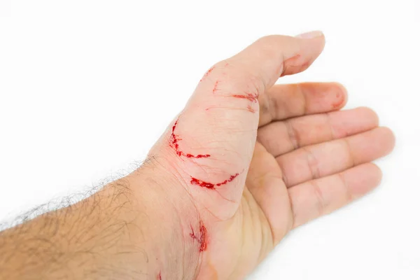 Fresh wound and blood from a bite cat — Stock Photo, Image