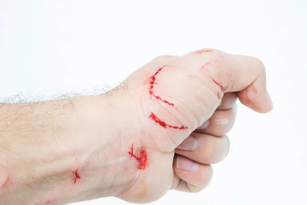 Fresh wound and blood from a bite cat — Stock Photo, Image