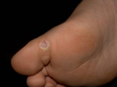 Bir çocuğun ayağının altında siğil, viral enfeksiyon deri hasarına neden oluyor, neredeyse salisilik asi ile tedavi ediliyor.