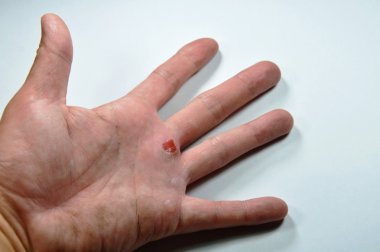 yandan işten sonra blister